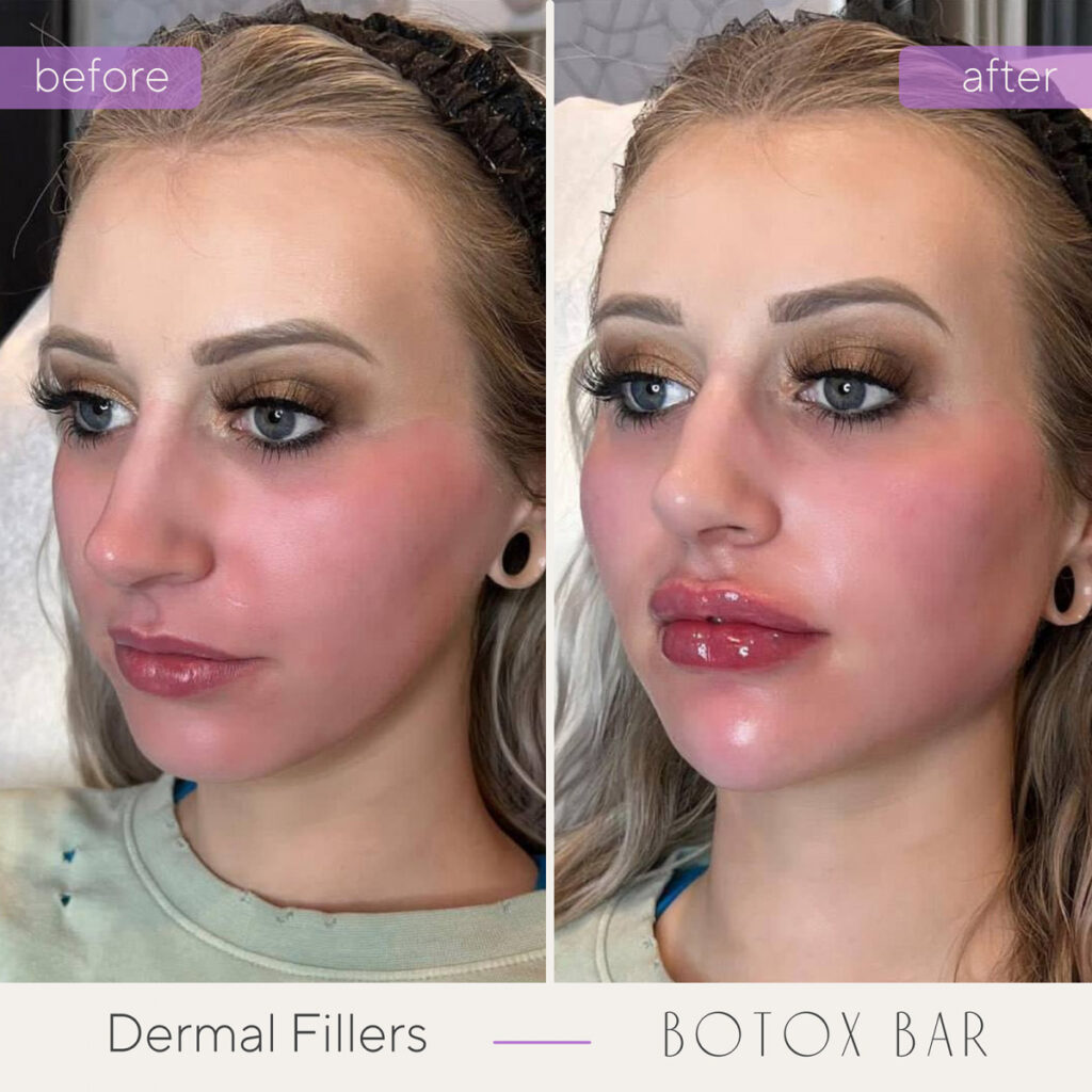 Before and After Dermal Fillers in The Botox Bar and Aesthetics at Dallas & Sherman, TX.