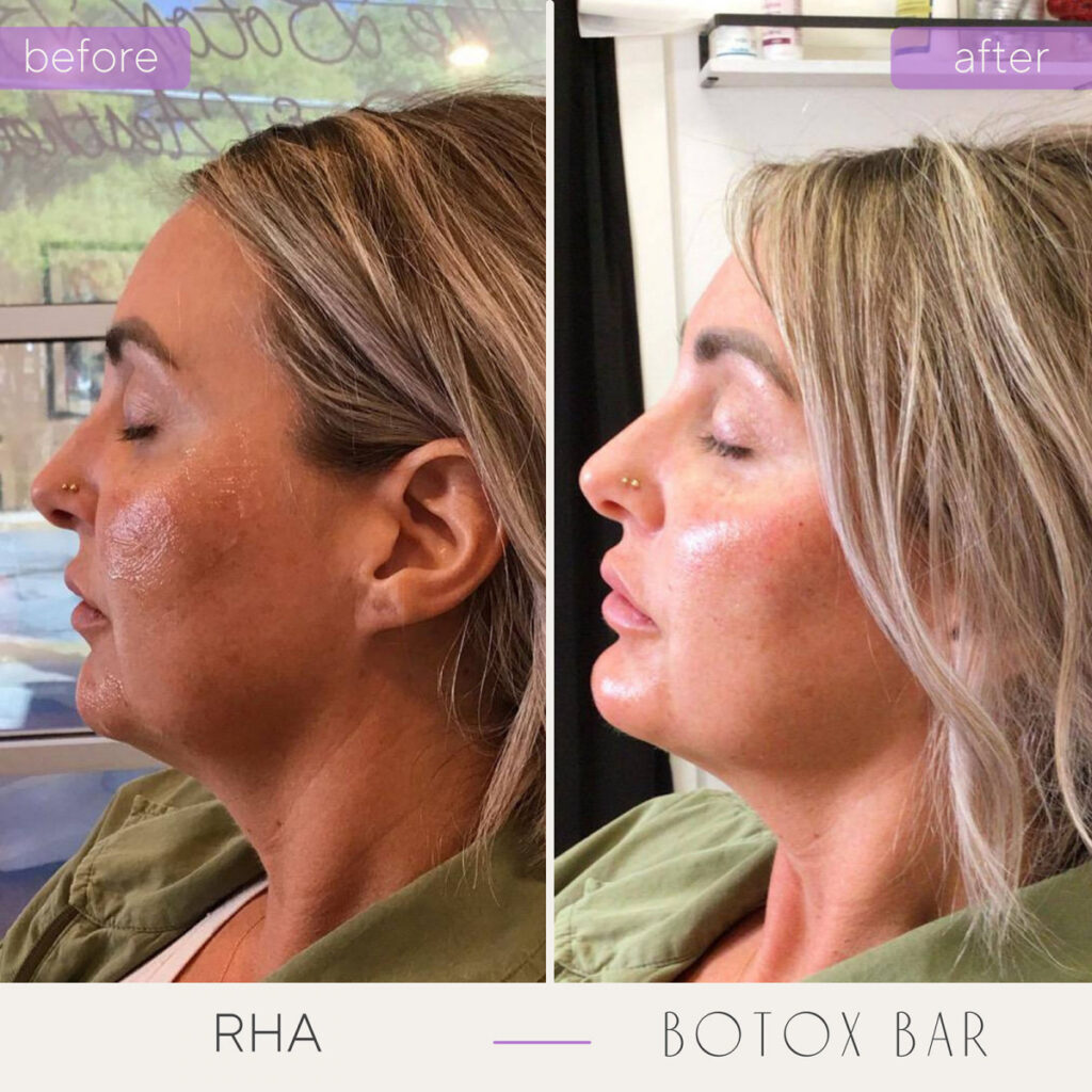 Before and After RHA in The Botox Bar and Aesthetics at Dallas & Sherman, TX.