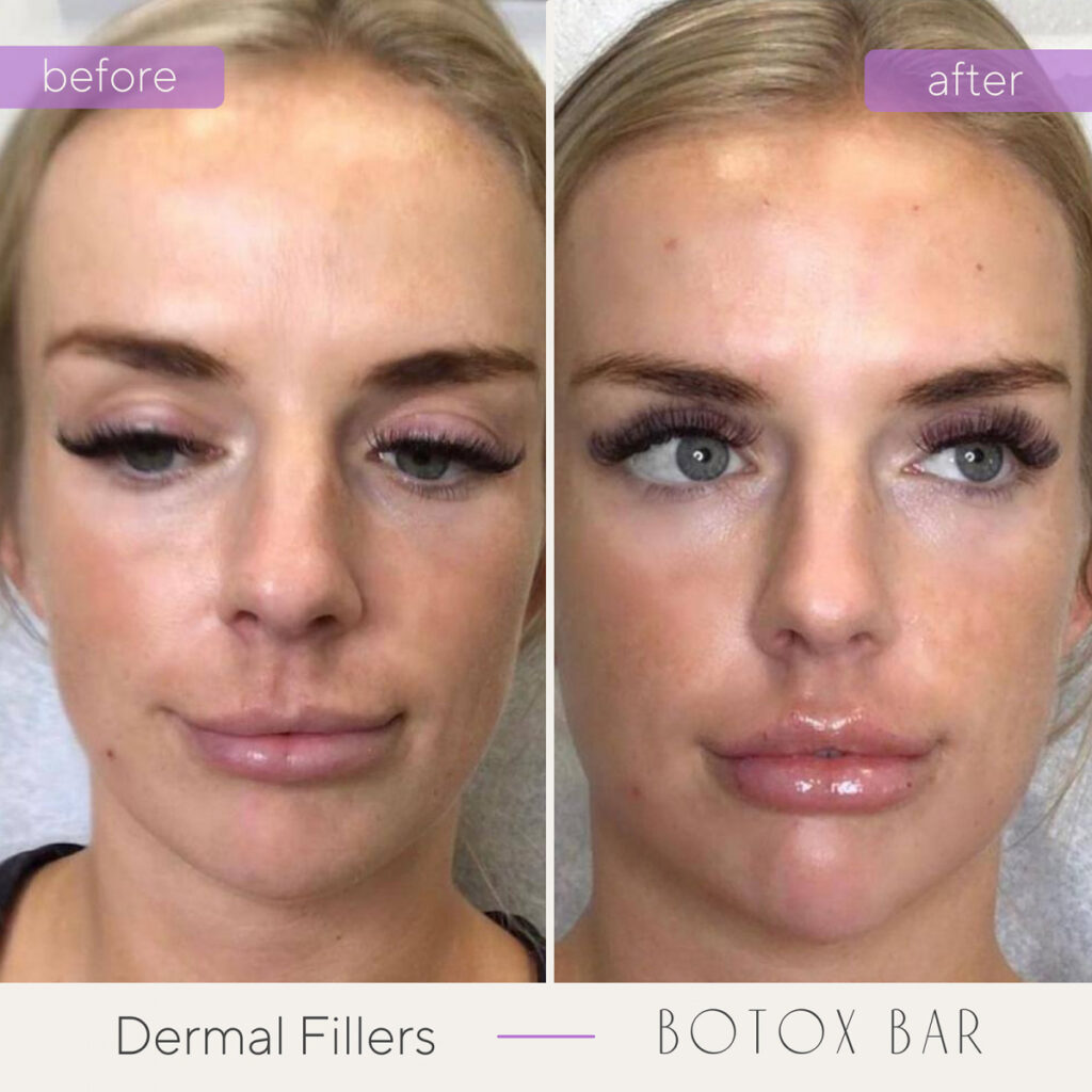 Before and After Dermal Fillers in The Botox Bar and Aesthetics at Dallas & Sherman, TX.