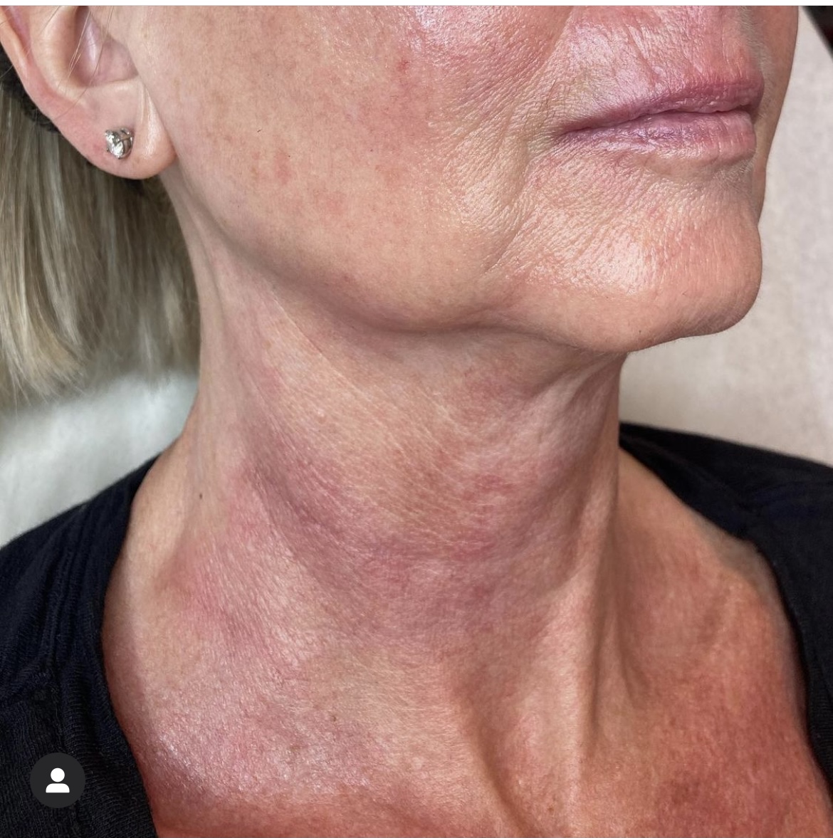 After PRX-T33 treatment result on a Women | The Botox Bar and Aesthetics at Dallas & Sherman, TX