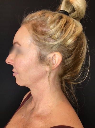 Before BeautiFill treatment on Women's face | The Botox Bar and Aesthetics at Dallas & Sherman, TX