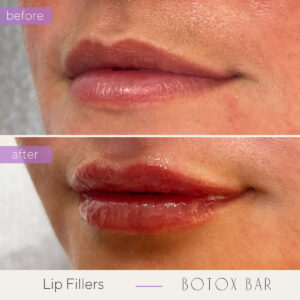 Before and After Lip Fillers in The Botox Bar and Aesthetics at Dallas & Sherman, TX