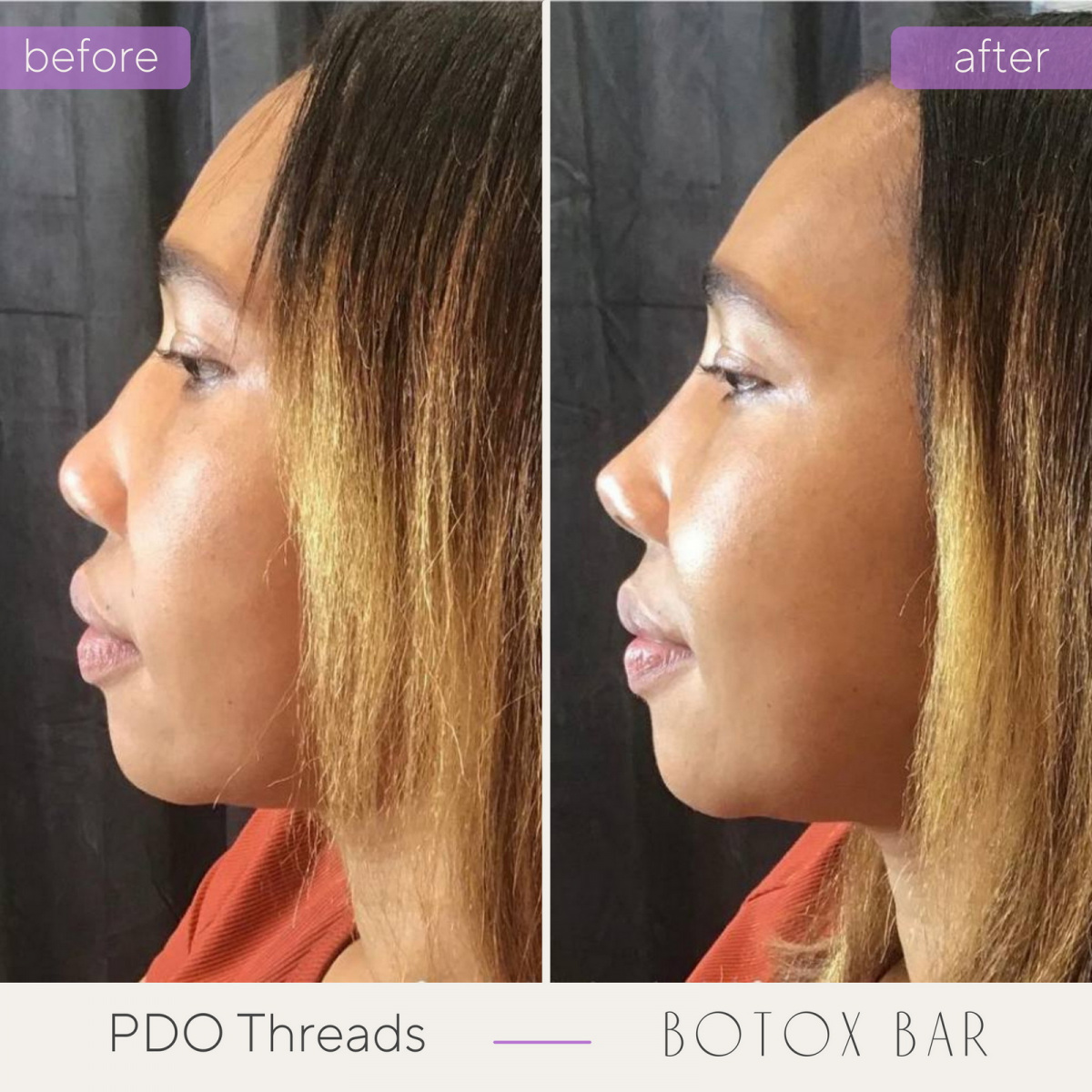 Before and After Liquid Nose Job in The Botox Bar and Aesthetics at Dallas & Sherman, TX