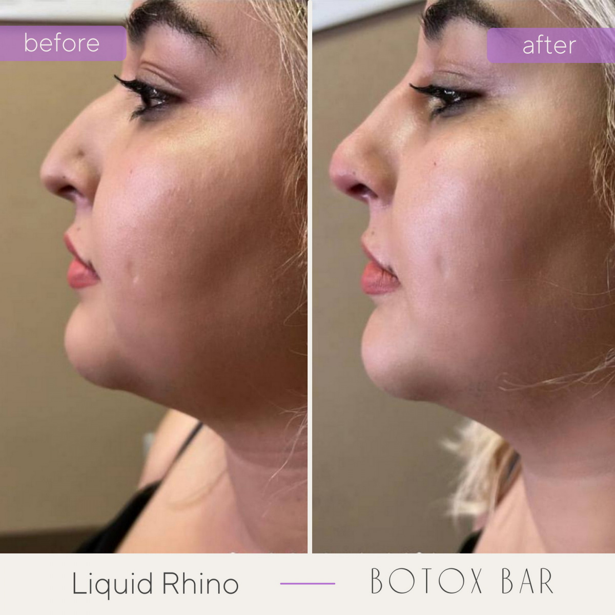 Before and After Liquid Rhino in The Botox Bar and Aesthetics at Dallas & Sherman, TX
