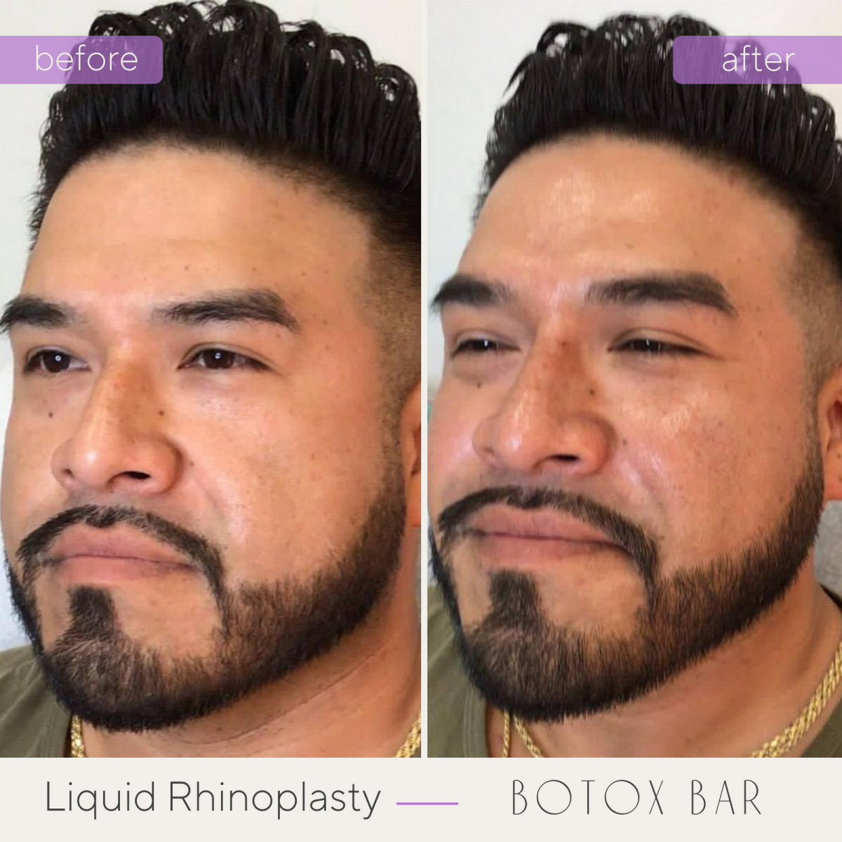 Before and After Liquid Rhinoplasty in The Botox Bar and Aesthetics at Dallas & Sherman, TX