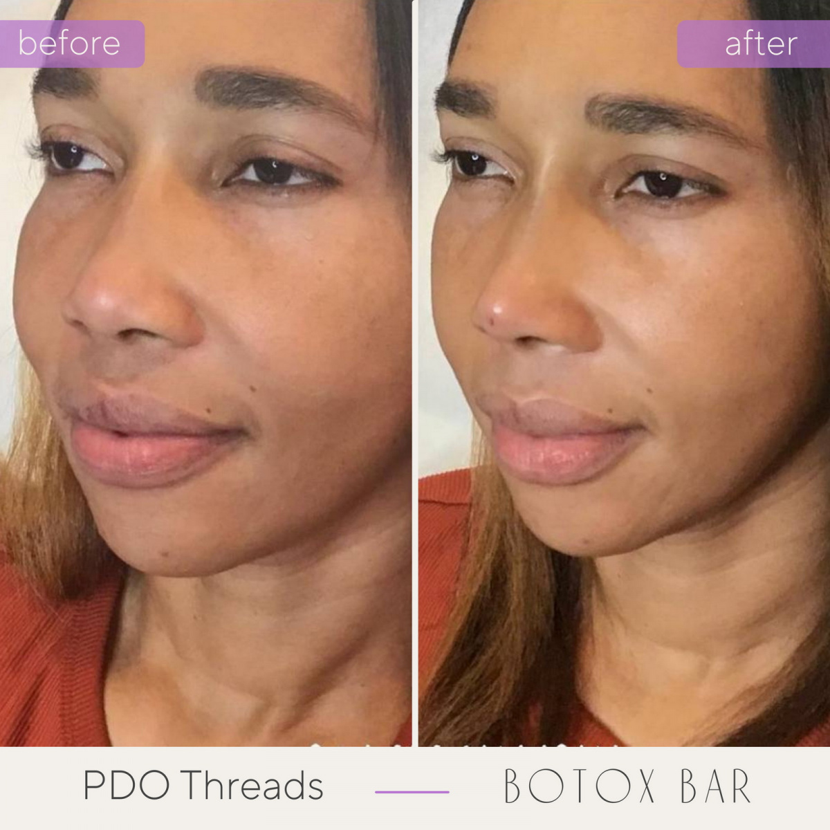 Before and After Liquid Nose Job in The Botox Bar and Aesthetics at Dallas & Sherman, TX