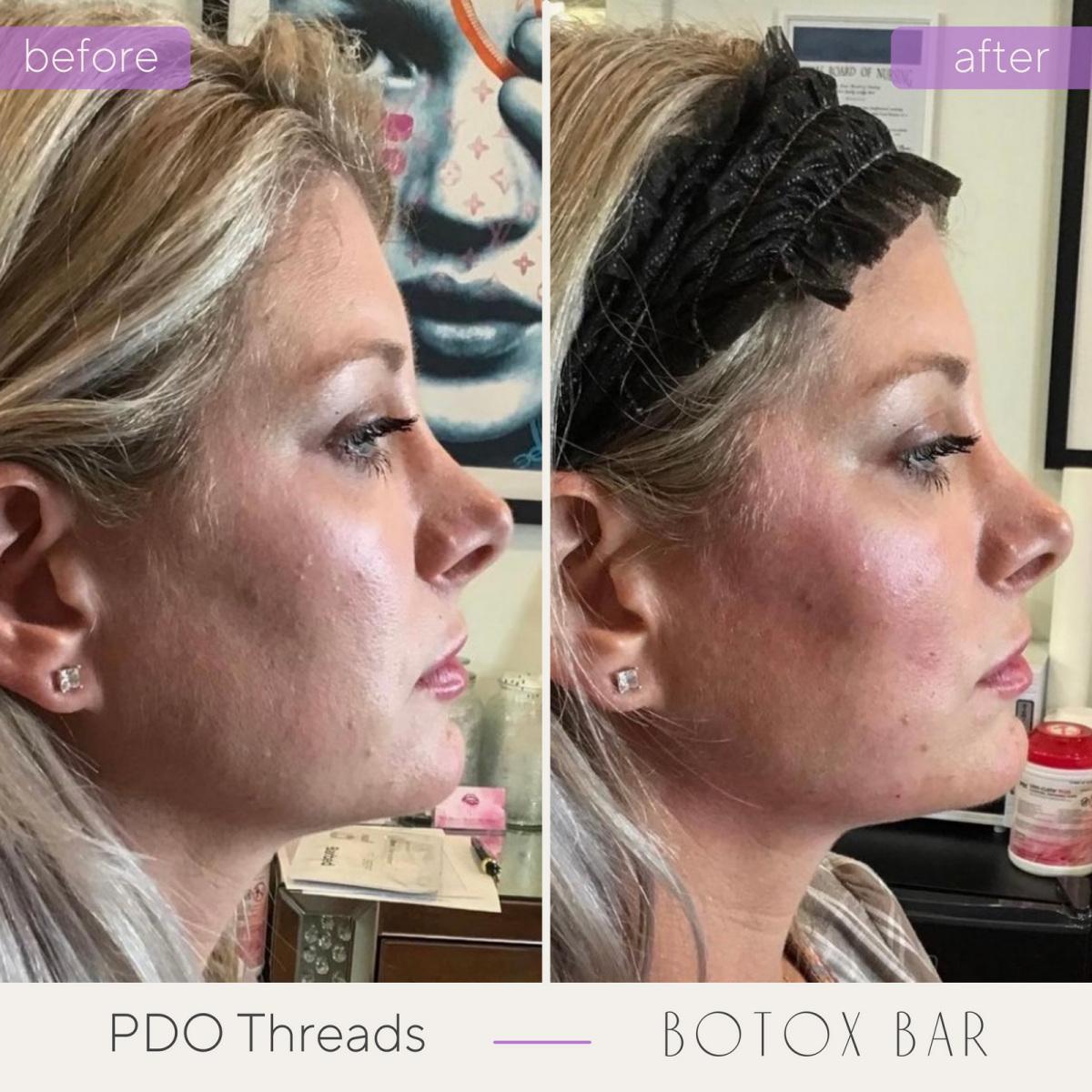 Before and After PDO Threads in The Botox Bar and Aesthetics at Dallas & Sherman, TX