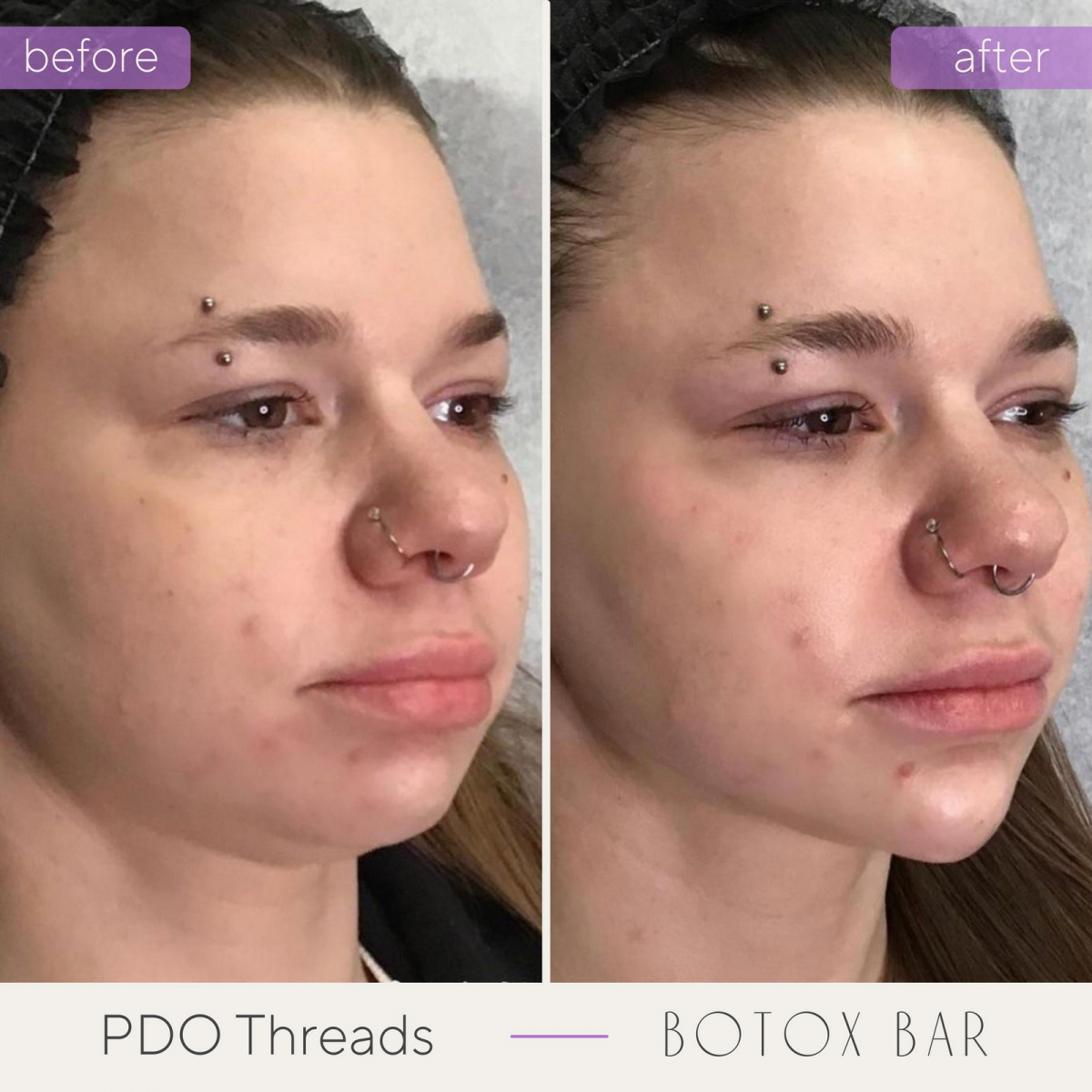 Before and After PDO Threads in The Botox Bar and Aesthetics at Dallas & Sherman, TX