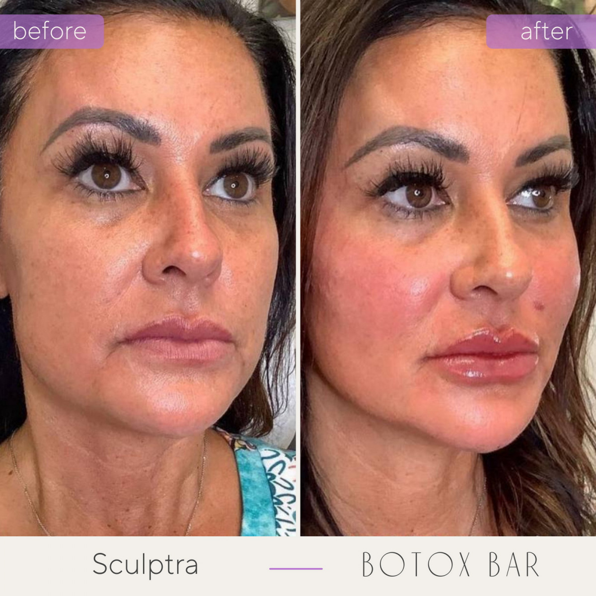 Before and After Sculptra treatment in The Botox Bar and Aesthetics at Dallas & Sherman, TX