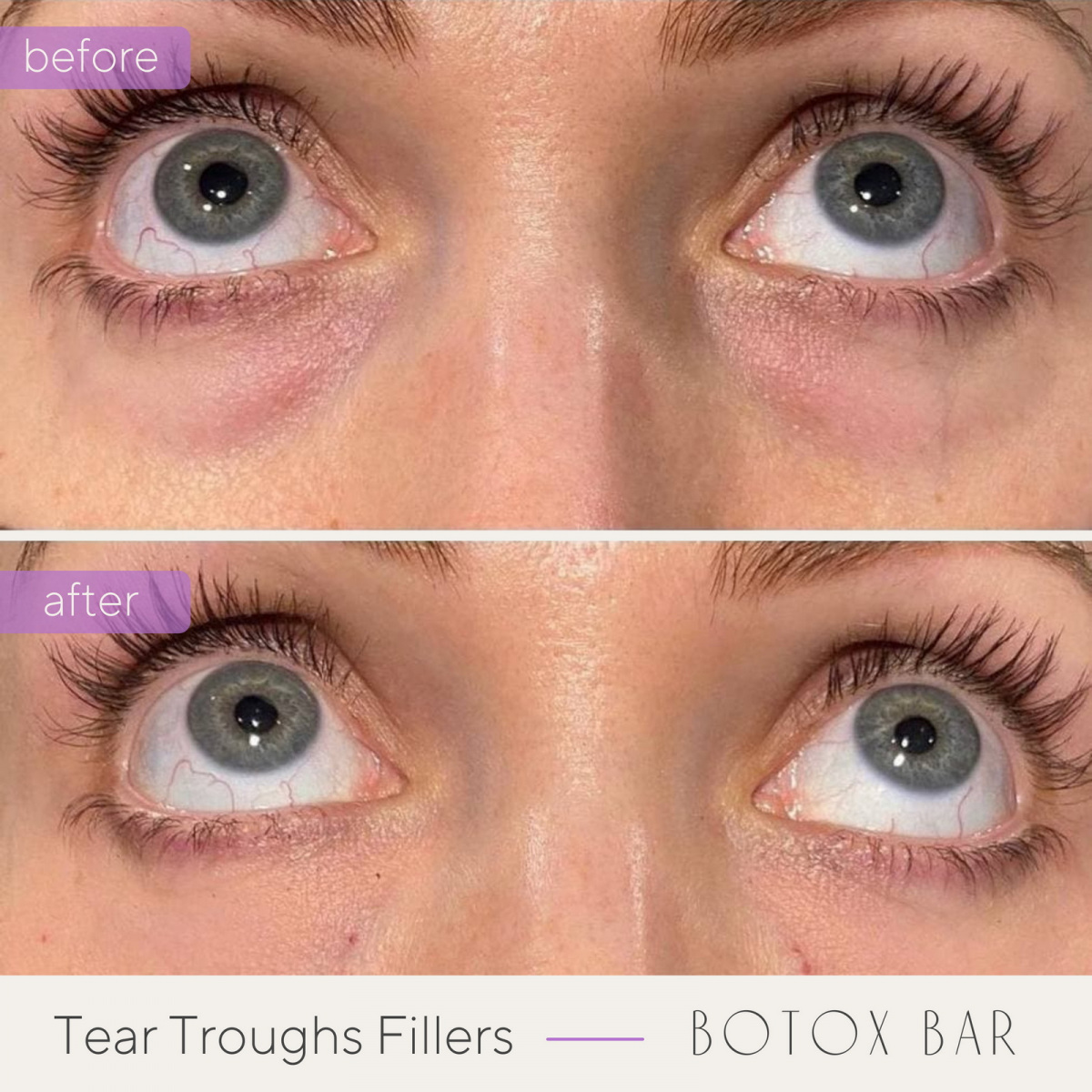 Before and After Tear Trough Fillers in The Botox Bar and Aesthetics at Dallas & Sherman, TX