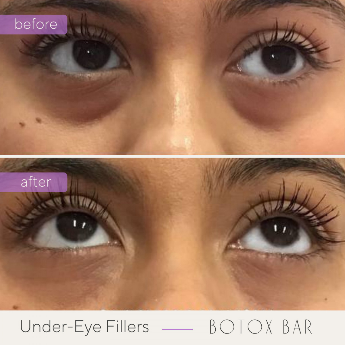 Before and After Under Eye Fillers in The Botox Bar and Aesthetics at Dallas & Sherman, TX
