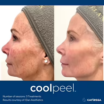 Before and After the result of Coolpeel Laser Treatment in The Botox Bar and Aesthetics at Dallas & Sherman, TX