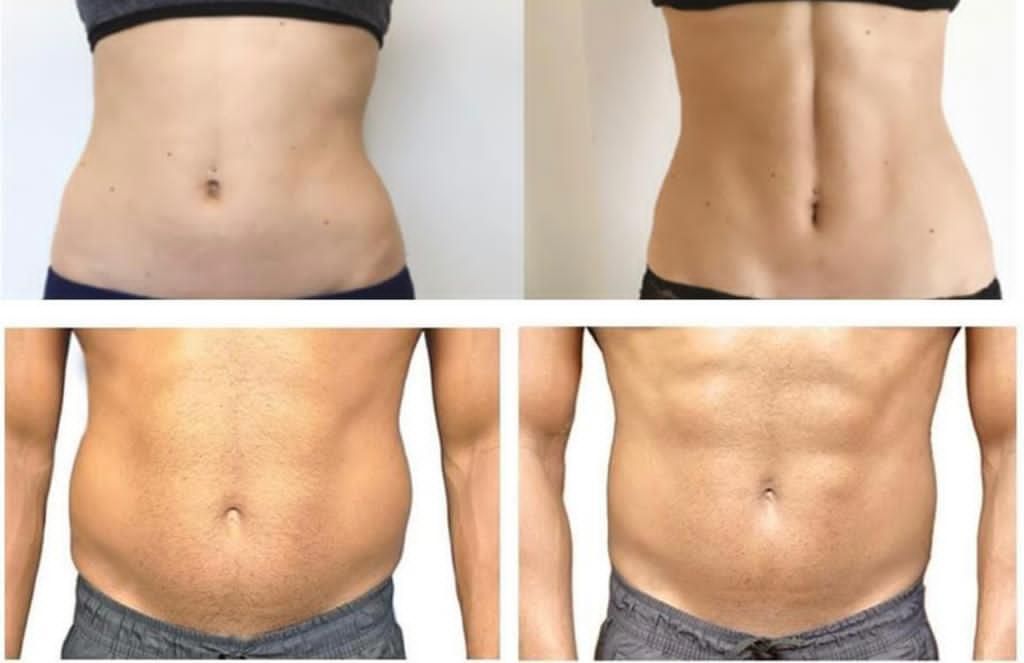 Before and After Body Contouring treatment in The Botox Bar and Aesthetics at Dallas & Sherman, TX