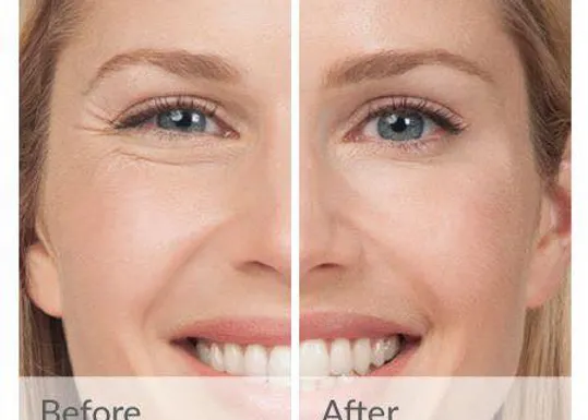 Before and After Neuromodulators treatment in The Botox Bar and Aesthetics at Dallas & Sherman, TX