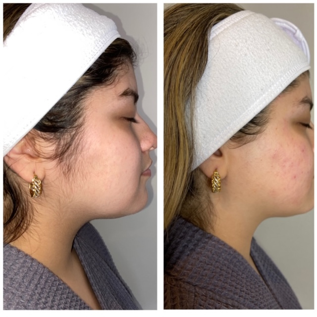 Dermaplane Before and After 1