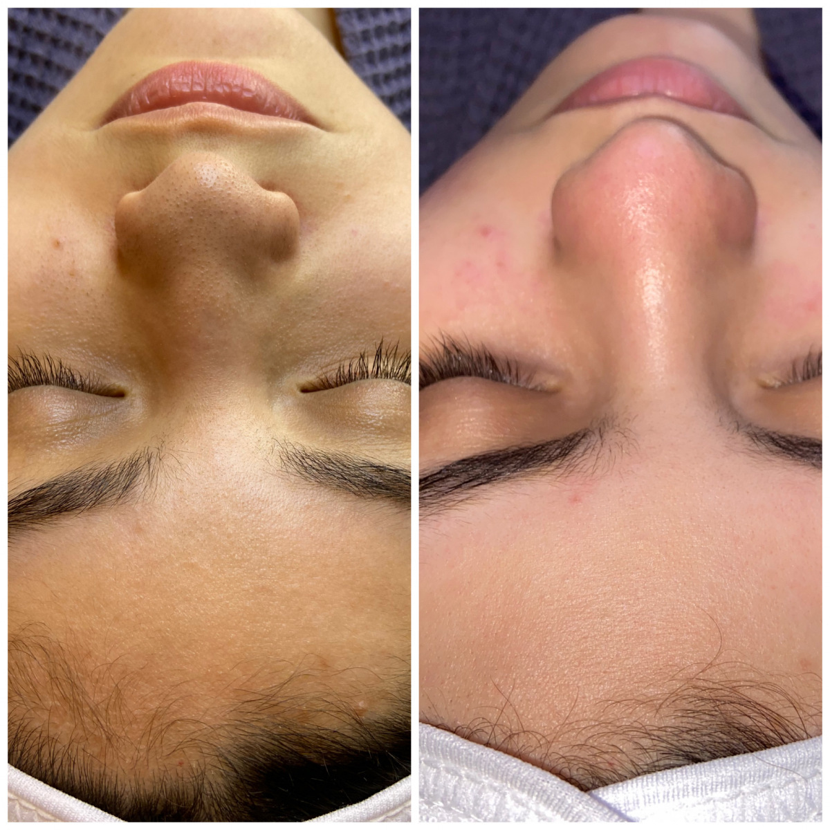 Dermaplane Before and After 2