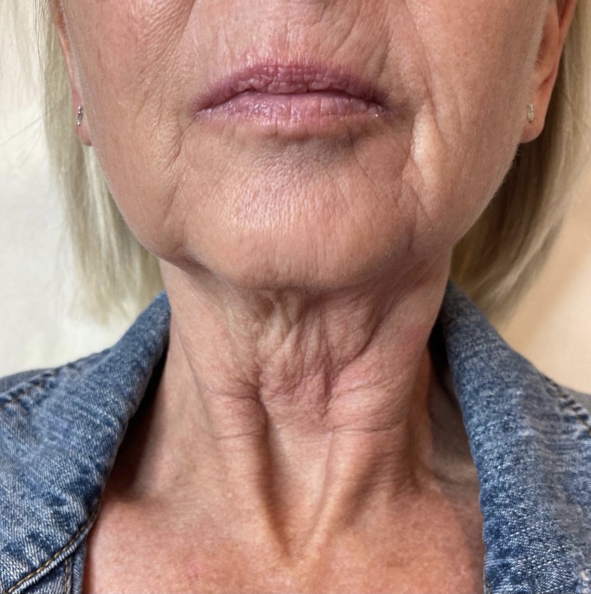 Before PRX-T33 treatment on a Women's face and neck | The Botox Bar and Aesthetics at Dallas & Sherman, TX