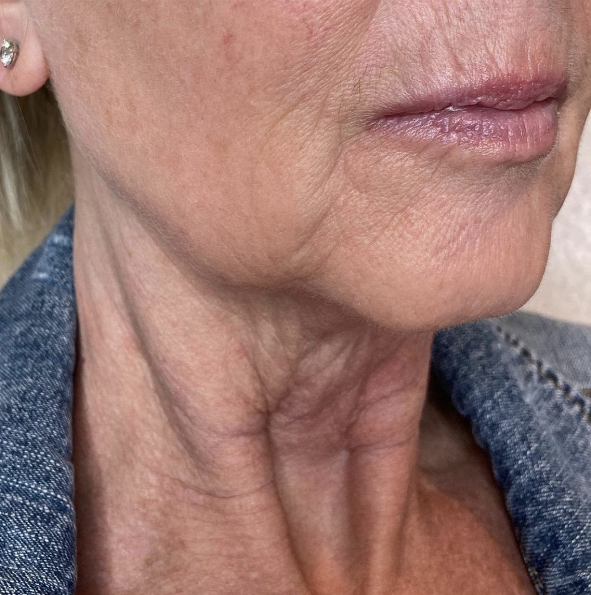Before PRX-T33 treatment on a Women | The Botox Bar and Aesthetics at Dallas & Sherman, TX