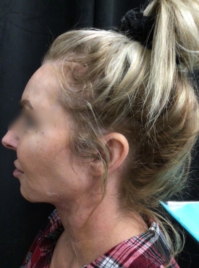 After BeautiFill treatment results on Women's face in The Botox Bar and Aesthetics at Dallas & Sherman, TX