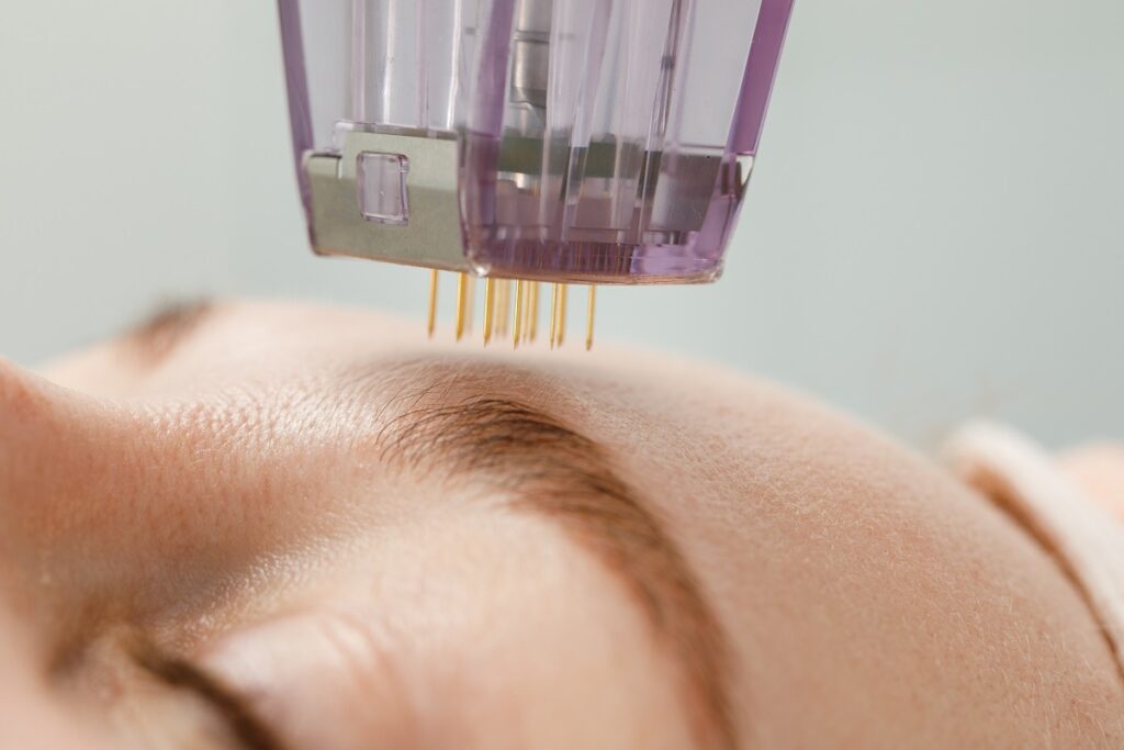 Women getting microneedling on forehead | Get Microneedling in The Botox Bar and Aesthetics at Dallas & Sherman, TX