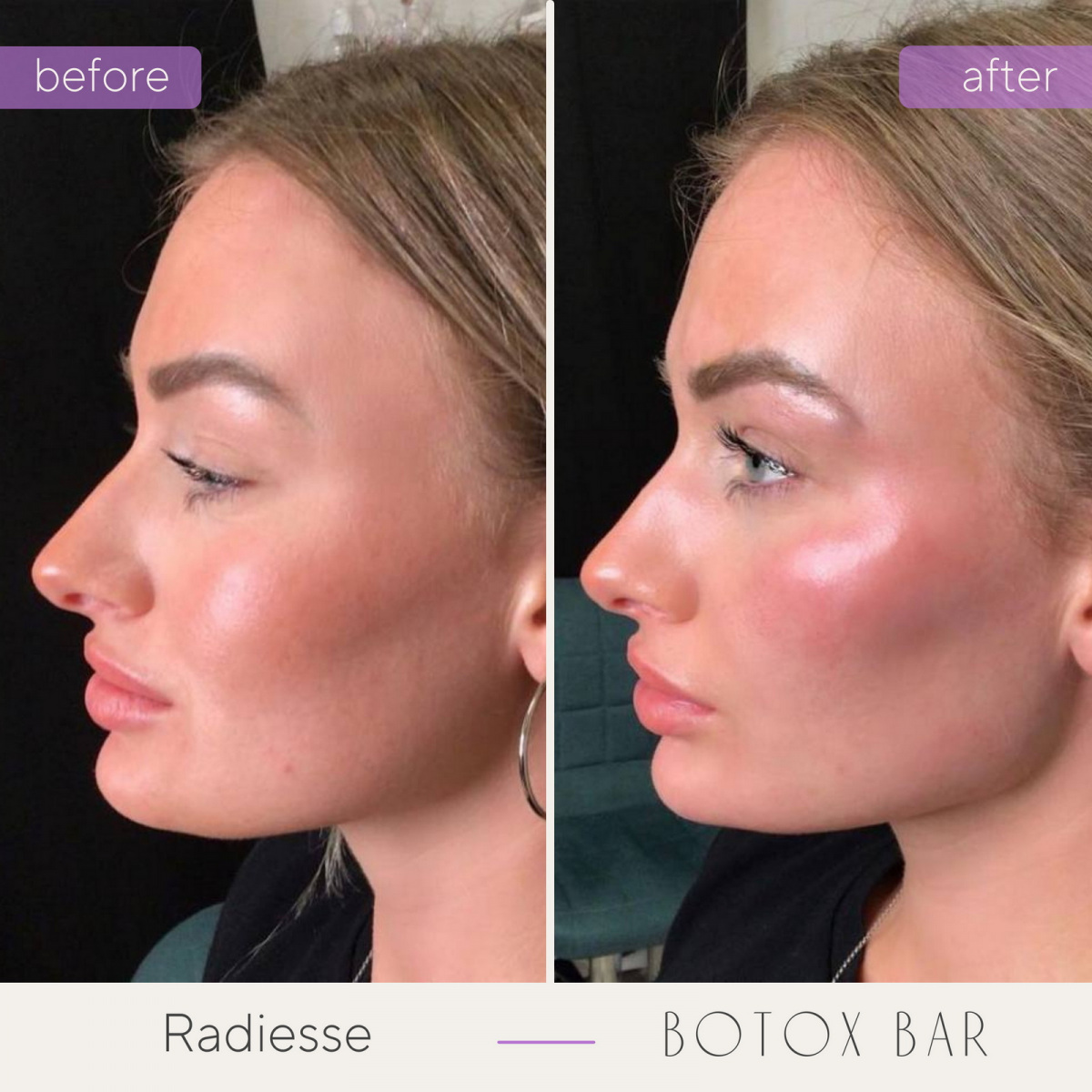 Before and After Radiesse treatment in The Botox Bar and Aesthetics at Dallas & Sherman, TX