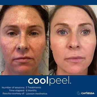 Before and After the result of Coolpeel Laser Treatment at The Botox Bar and Aesthetics at Dallas & Sherman, TX