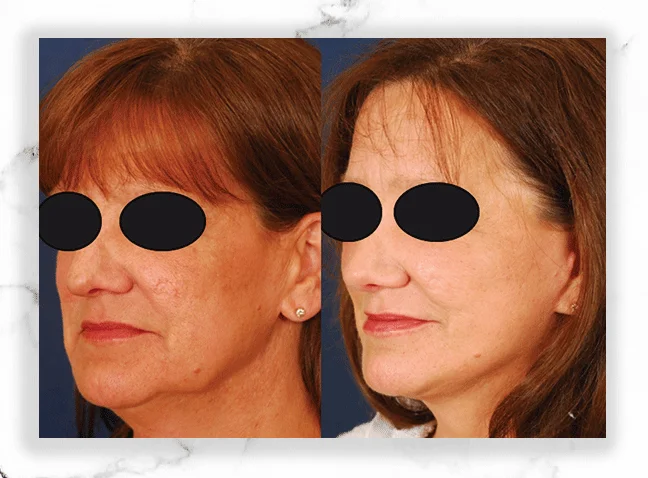 Before and After the result of BeautiFill treatment on Women's face | The Botox Bar and Aesthetics at Dallas & Sherman, TX.