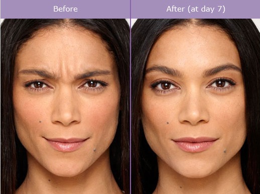 Before and After Neuromodulators treatment in The Botox Bar and Aesthetics at Dallas & Sherman, TX